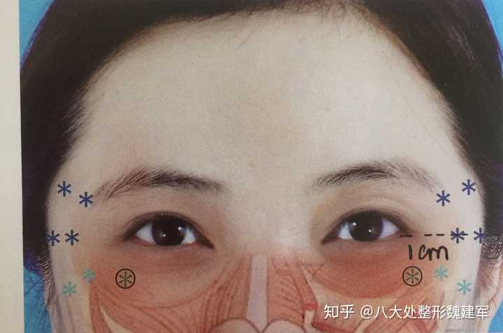 注射玻尿酸和肉毒素不同部位的疼痛感有何不同?