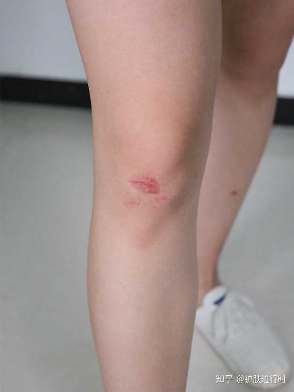 摔伤留下的疤痕怎么祛除效果好?