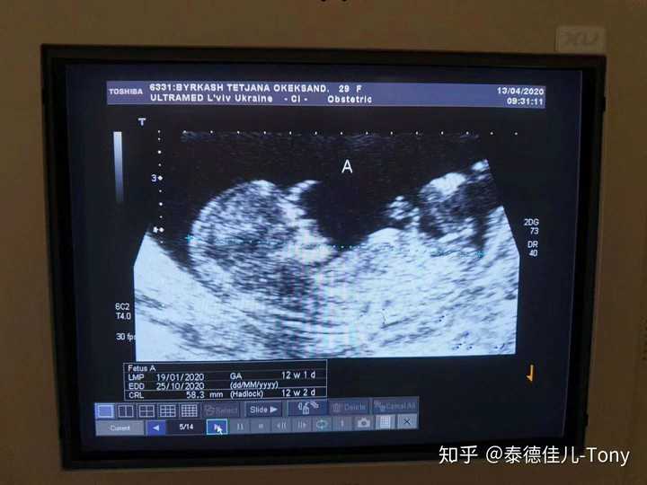 怀孕16周胎儿彩超图片图片