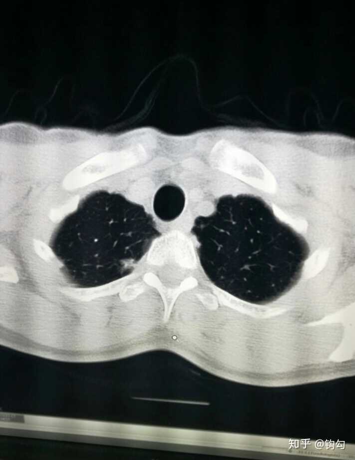 什么叫肺部纤维增殖灶?