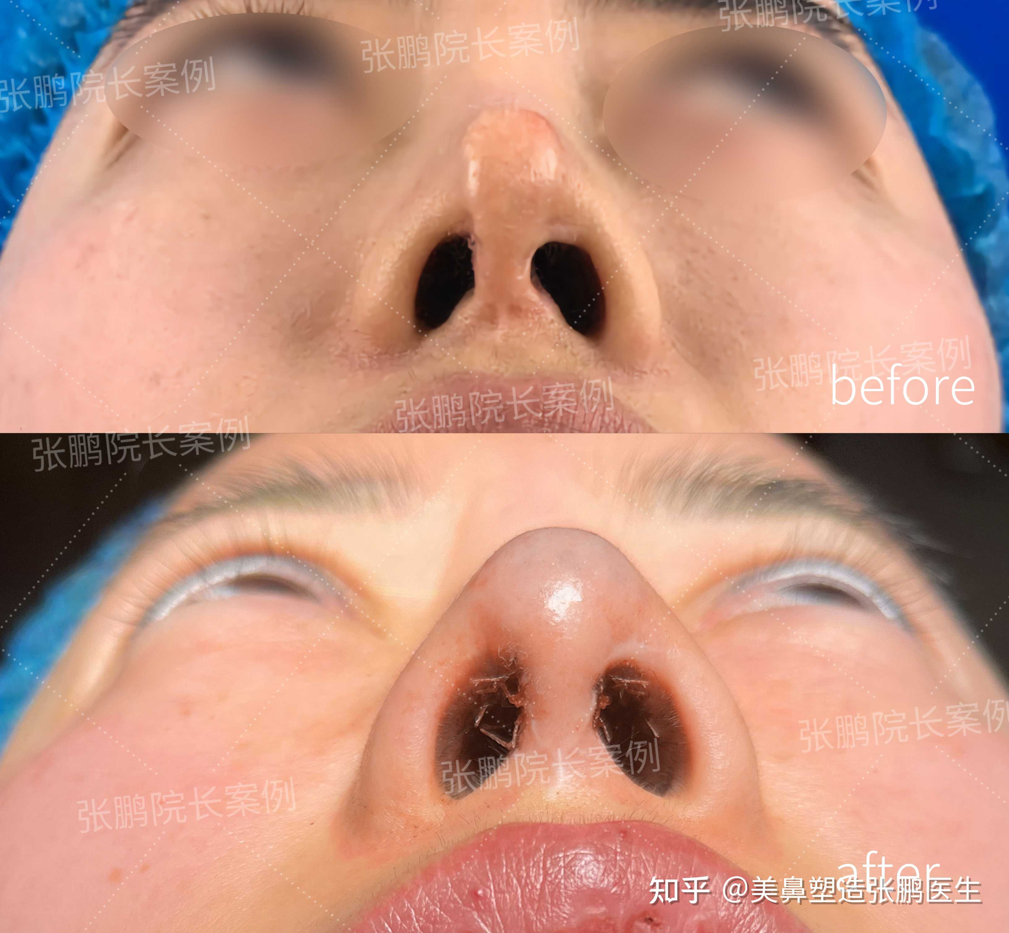 美鼻塑造张鹏医生