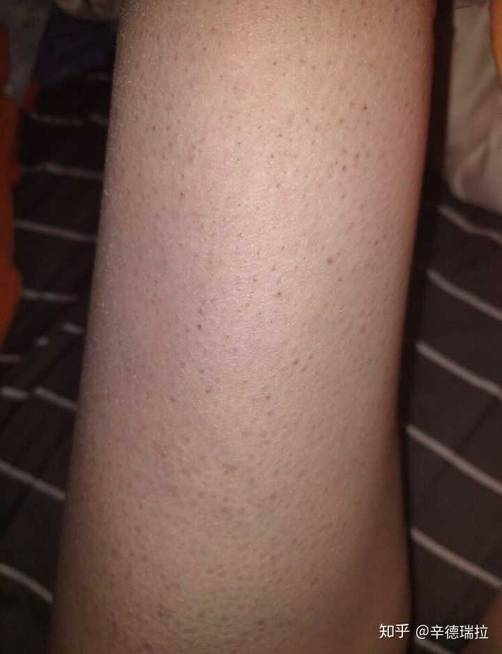 身上长有鱼鳞病就是常说的蛇皮怎么办夏天小腿皮肤看着那样的裂纹很丑