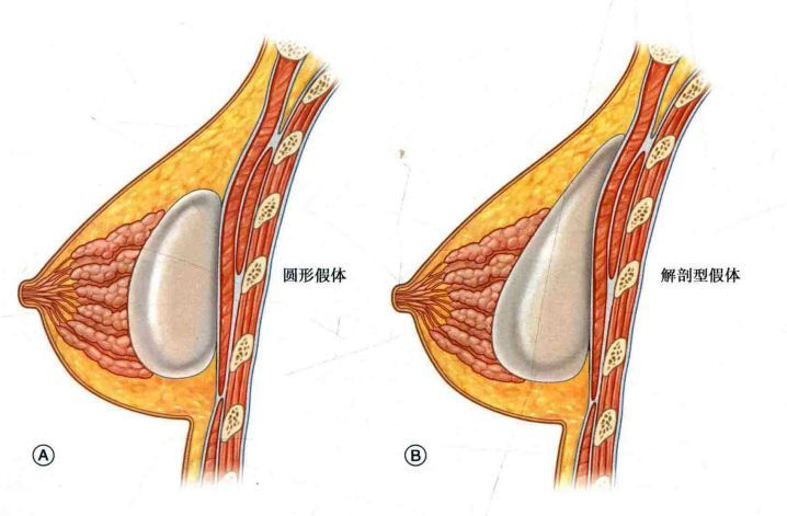 假体隆胸和自体脂肪隆胸都各有何风险呢?