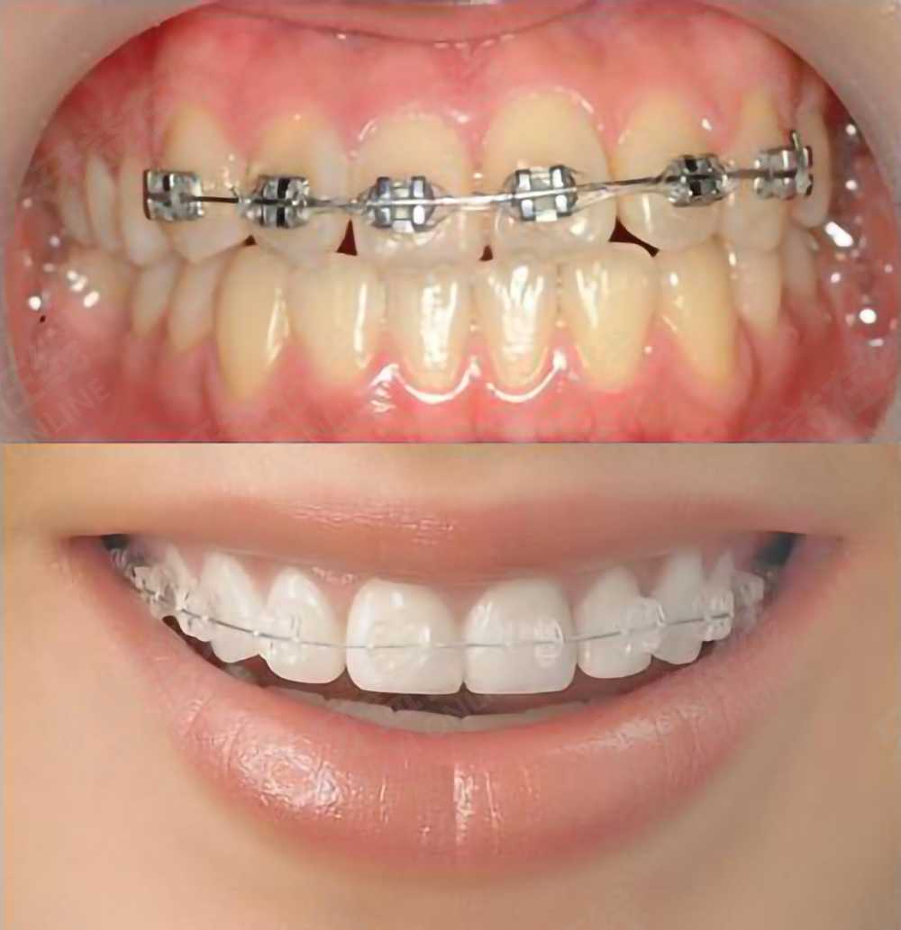 牙益在线传统矫治器vs新型自锁矫治器