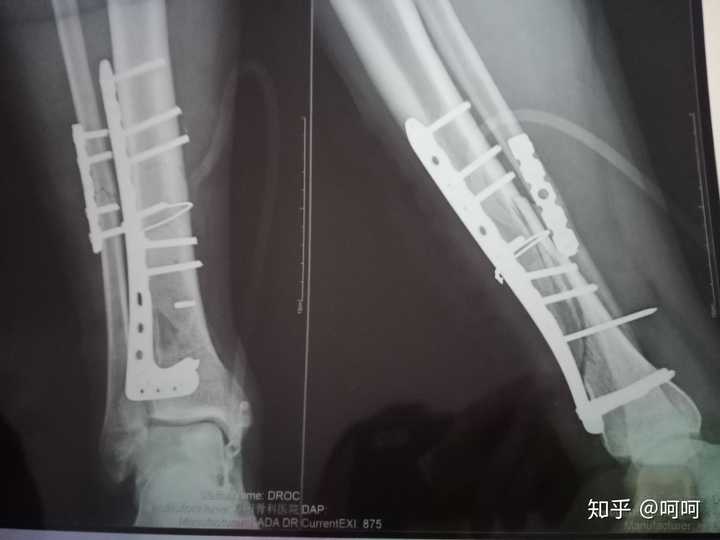 请问小腿胫腓骨骨折多久可以愈合 知乎 请问小腿胫腓骨骨折多久可以愈合 知乎