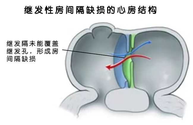 先心病房间隔缺损多大必须手术 知乎