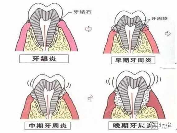 牙周炎怎么根治? - 知乎