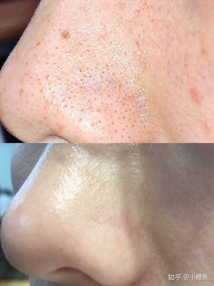 有哪些可以改善鼻翼两侧毛孔粗大和黑头现象的方法 知乎