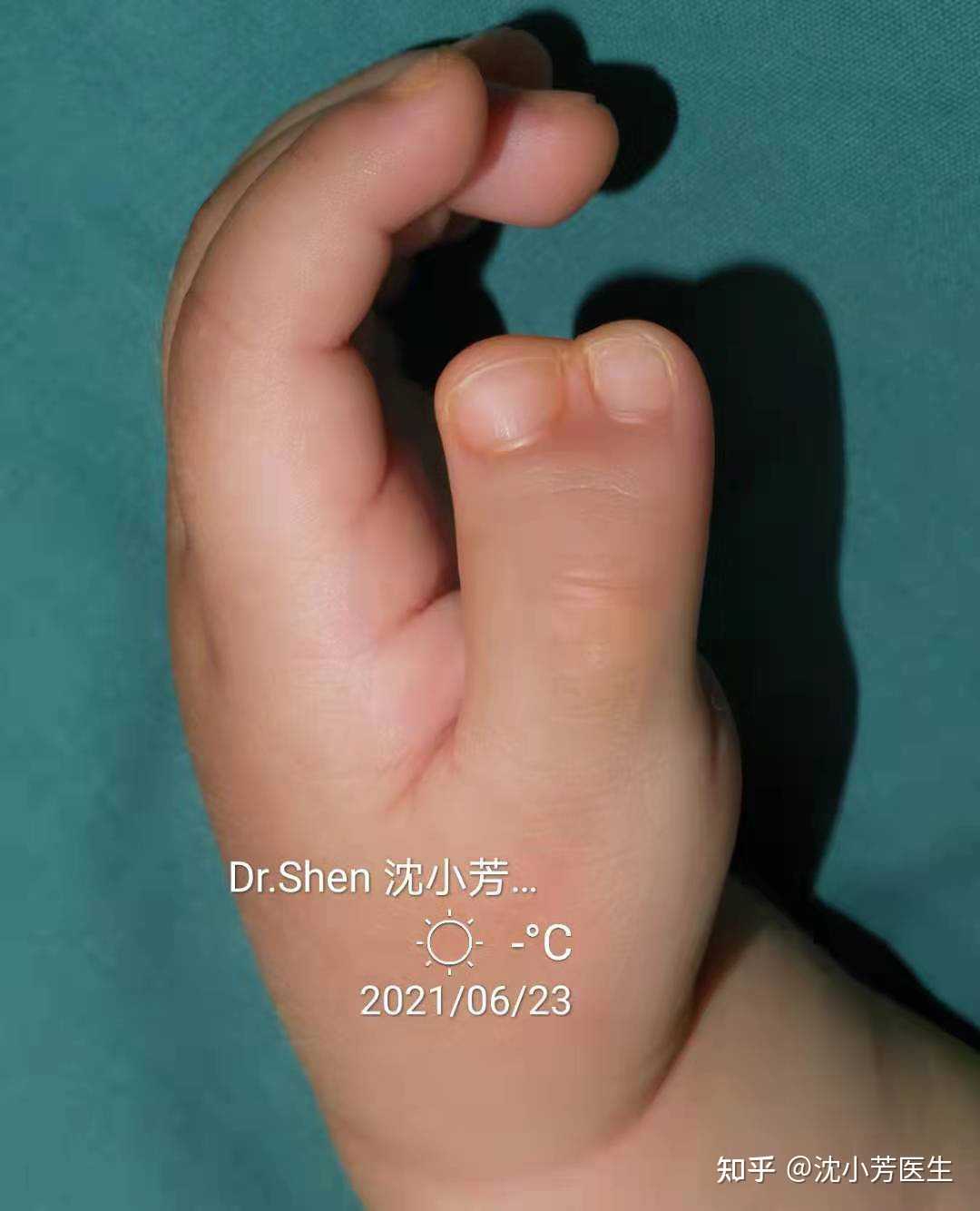 沈小芳医生 的想法: 常见的ii型复拇,也往往需要近节截骨来矫