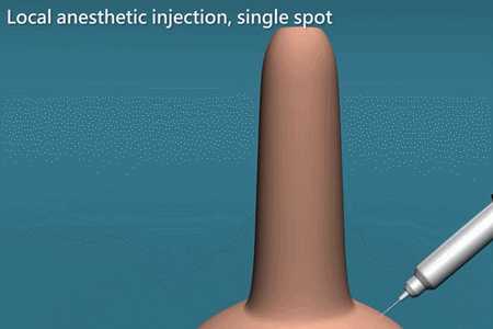 经历割包皮手术是怎样的一种体验