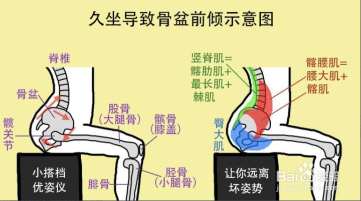 如何改善骨盆前倾?