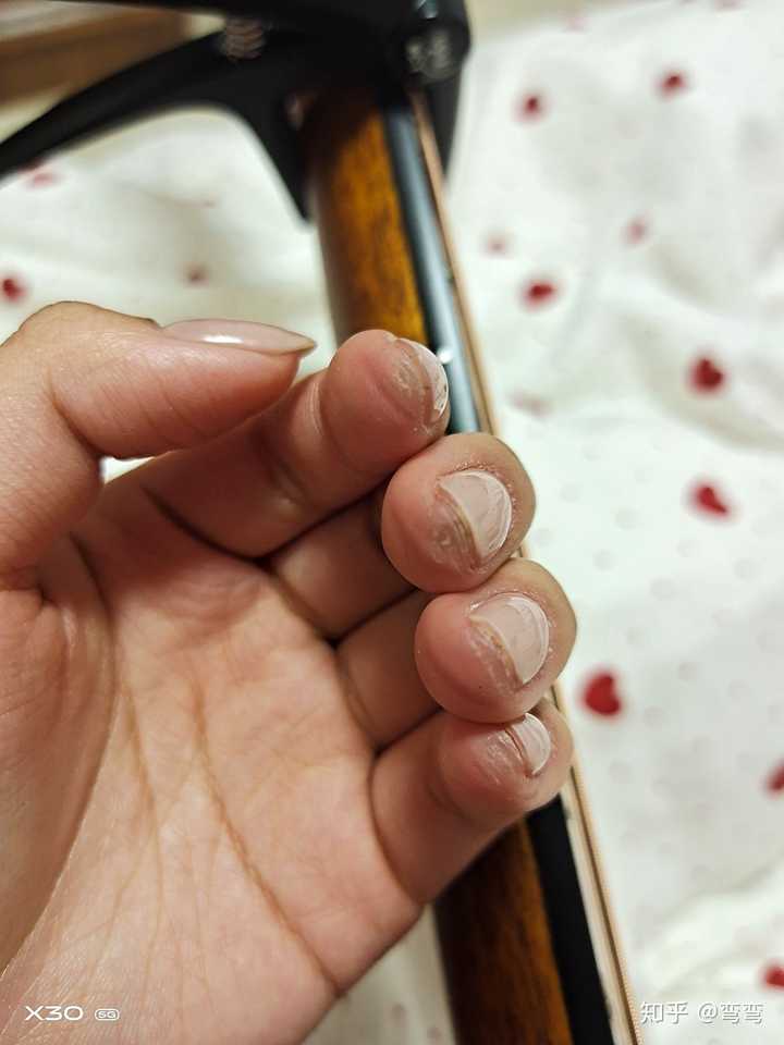 学吉他时,手指这样了,还练吗?