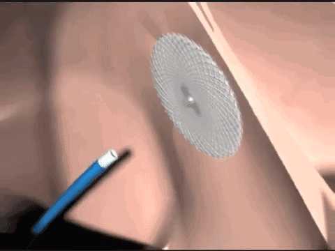 先心病房间隔缺损多大必须手术?