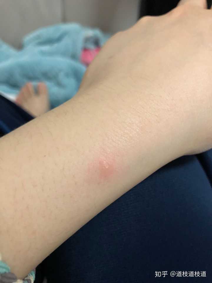被蟑螂咬是一种什么体验 道枝道枝道的回答 知乎 被蟑螂咬是一种什么体验 道枝道枝道的回答 知乎