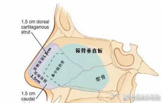 取出量越多創傷越大,鼻粘膜就容易出現破潰或血腫,進而造成鼻中隔創口