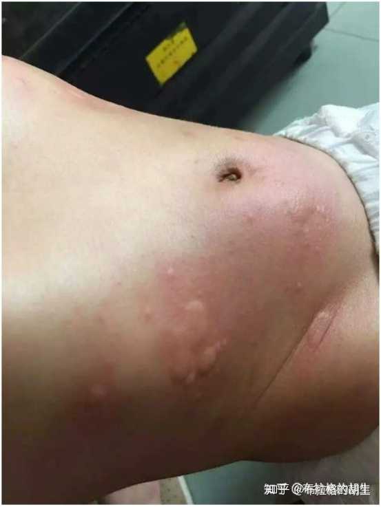 皮肤过敏荨麻疹能通过多运动锻炼增强免疫力改善吗 知乎 皮肤过敏荨麻疹能通过多运动锻炼增强免疫力改善吗 知乎