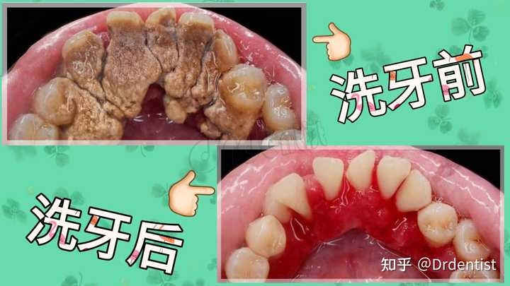 洗牙的过程是怎样的 洗牙后有哪些需要注意的 知乎 洗牙的过程是怎样的 洗牙后有哪些需要注意的 知乎