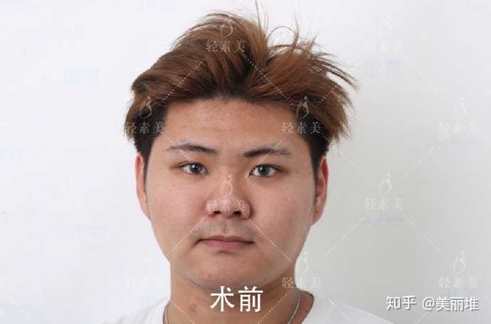 小鼻子男生怎么变好看?