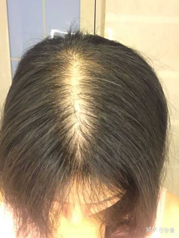 脱发真的能治好吗?