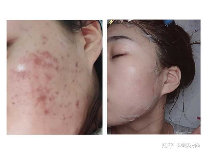 这是饿刷酸刷成这样的当时真把我吓毁了  然后就服这个医美面膜三天差