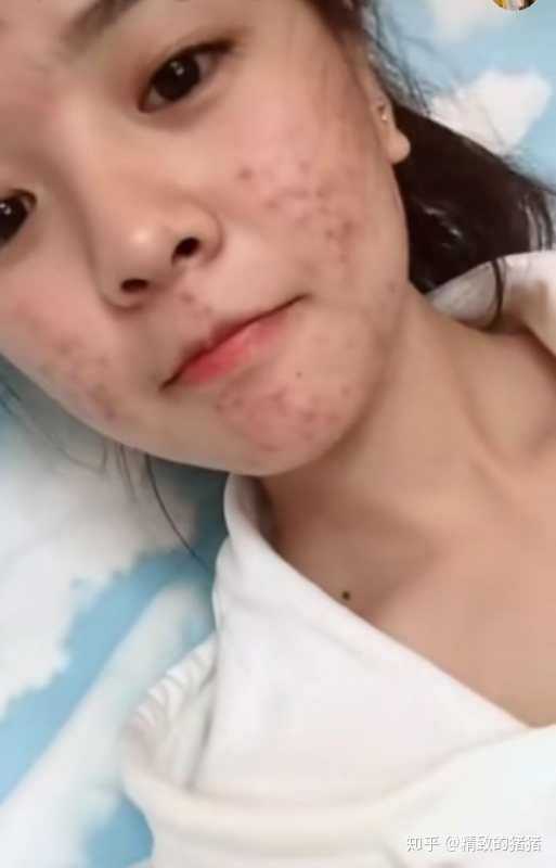 求推荐!本人混油皮有痘痘!求不闷痘的!