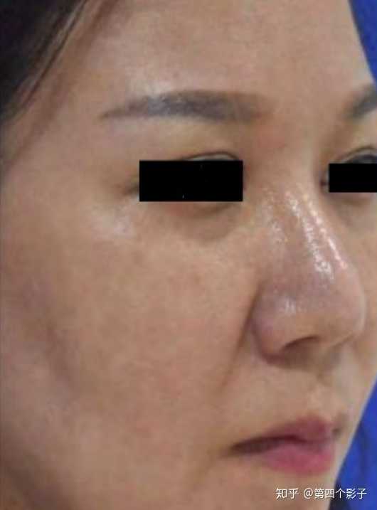 怎样改善皮肤 拯救毛孔粗大 第四个影子的回答 知乎