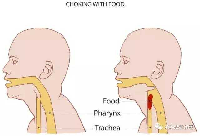 食物进入气管图片