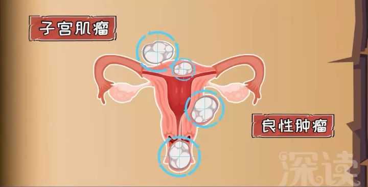 月經期經常生氣容易得子宮肌瘤麼?