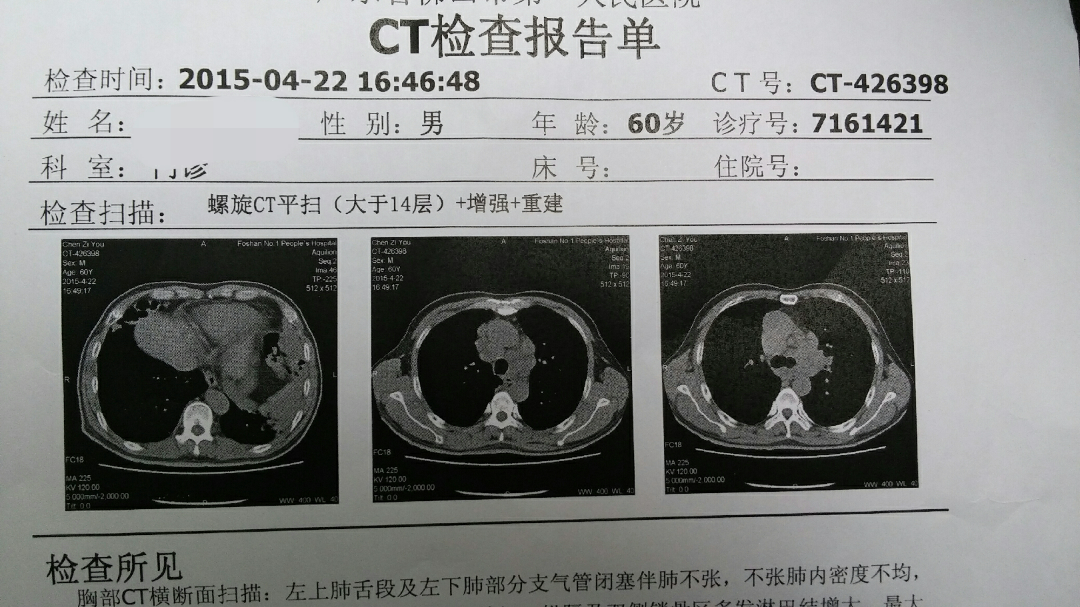 ct檢查是否可以確診肺癌?藥膳調理身體後再去化療是否可取?