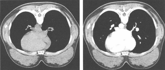 正常乳腺ct表现