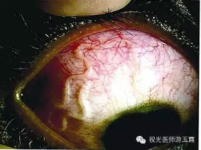 眼睛里面有寄生虫 是不是快瞎了 知乎 眼睛里面有寄生虫 是不是快瞎了 知乎