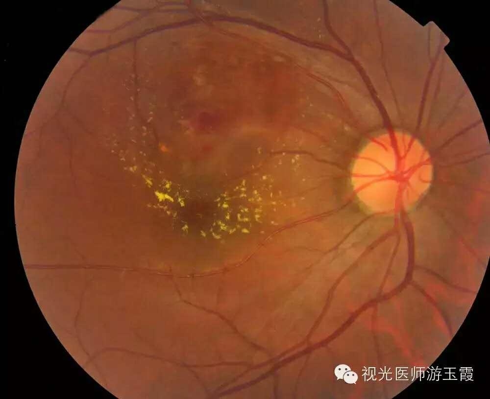 来看视网膜静脉阻塞患者眼底出血吸收全过程