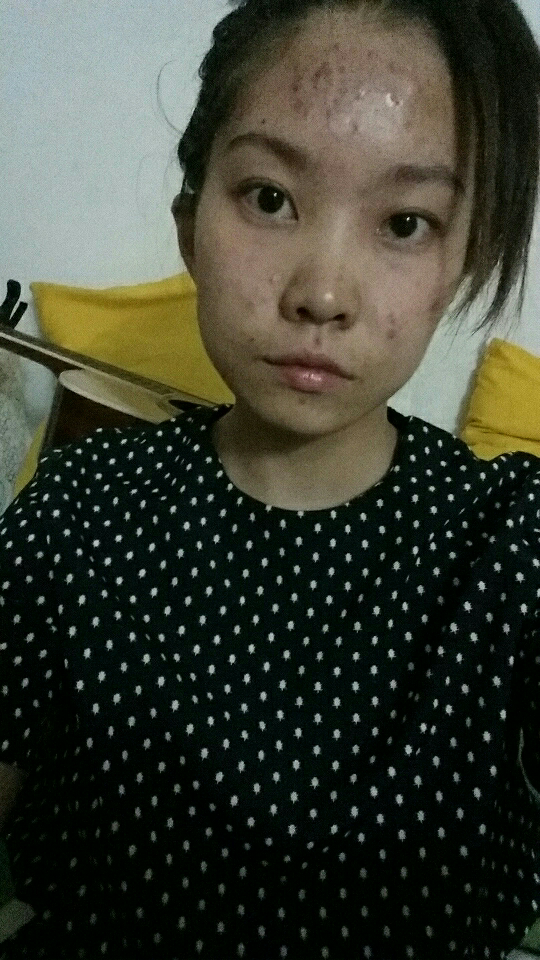 激素依赖性皮炎通常如何治疗? - 健康 - 知乎