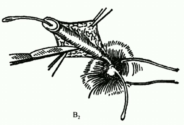 肛瘘手术痛苦吗?多久能康复?