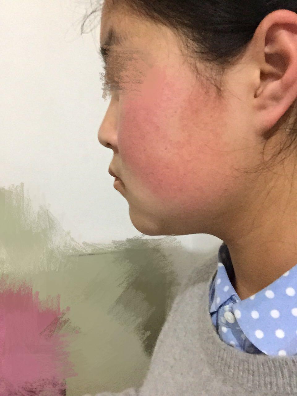 大家觉得有必要二次矫正吗? - 牙齿正畸 - 知乎