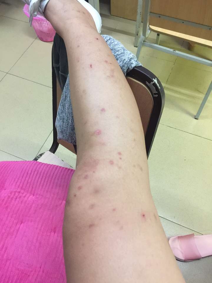 我的腿被蚊子咬得体无完肤(带图),怎样有效地消除蚊子印?