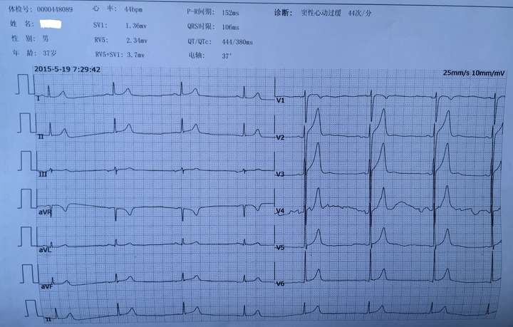 我的心電圖是否正常,有點擔心!