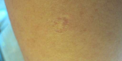 被雪藏15年终成为救命良方 他发明的卡介苗为全人类撑起了白色瘟疫的保护伞 知乎