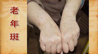 老年斑能够去掉吗