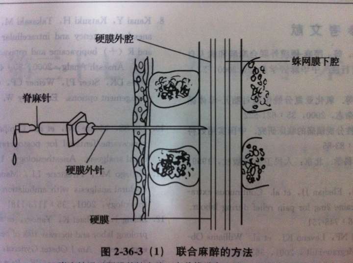 生孩子过程中使用硬膜外麻醉好不好?