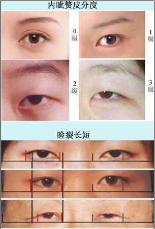 据国内外学者研究,先天性内眦赘皮为常染色体显性遗传,与臀部青斑,铲