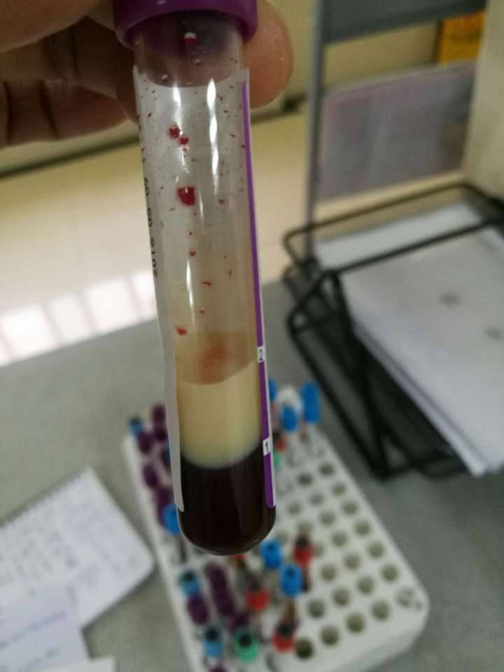 =====补充的分割线===== 这是高脂血症性重症胰腺炎患者抽出来的血,并