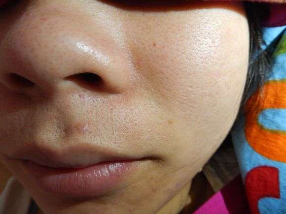 如何判定是否为器质性毛孔粗大