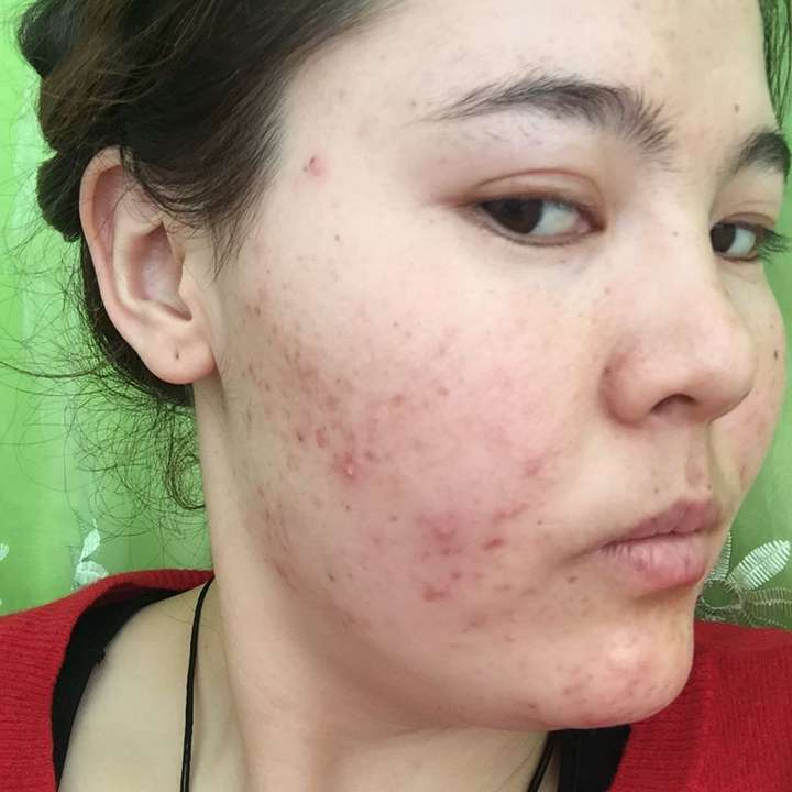 我也是长痘痘,都一年了,没好,求大神帮忙
