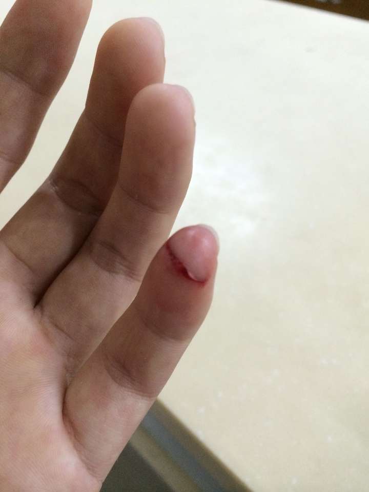 食堂特难吃,一次在宿舍做饭(平常在家从来不进厨房),把小拇指切了,切