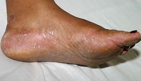 你是怎么治好脚气的?