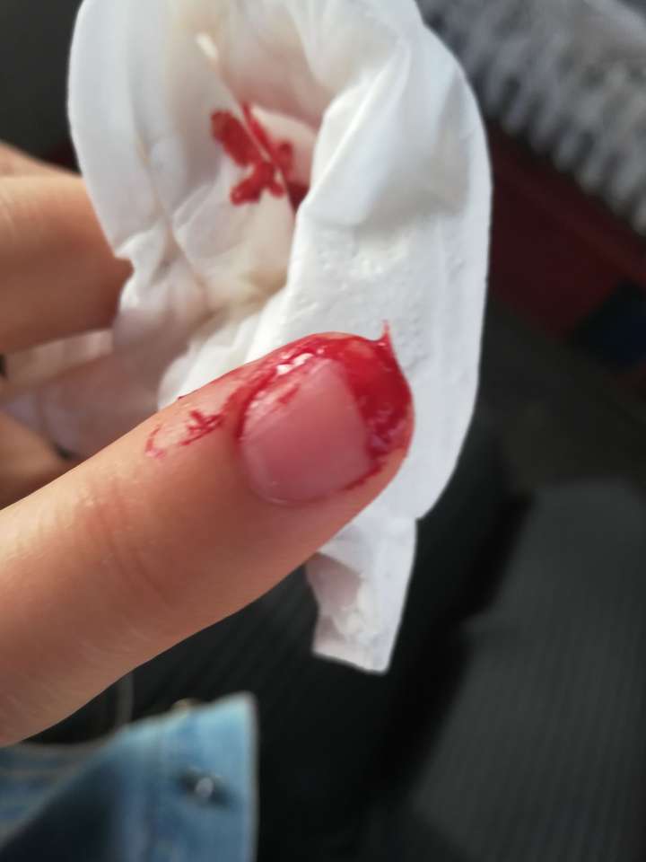 指甲盖掉了是怎样的一种体验?