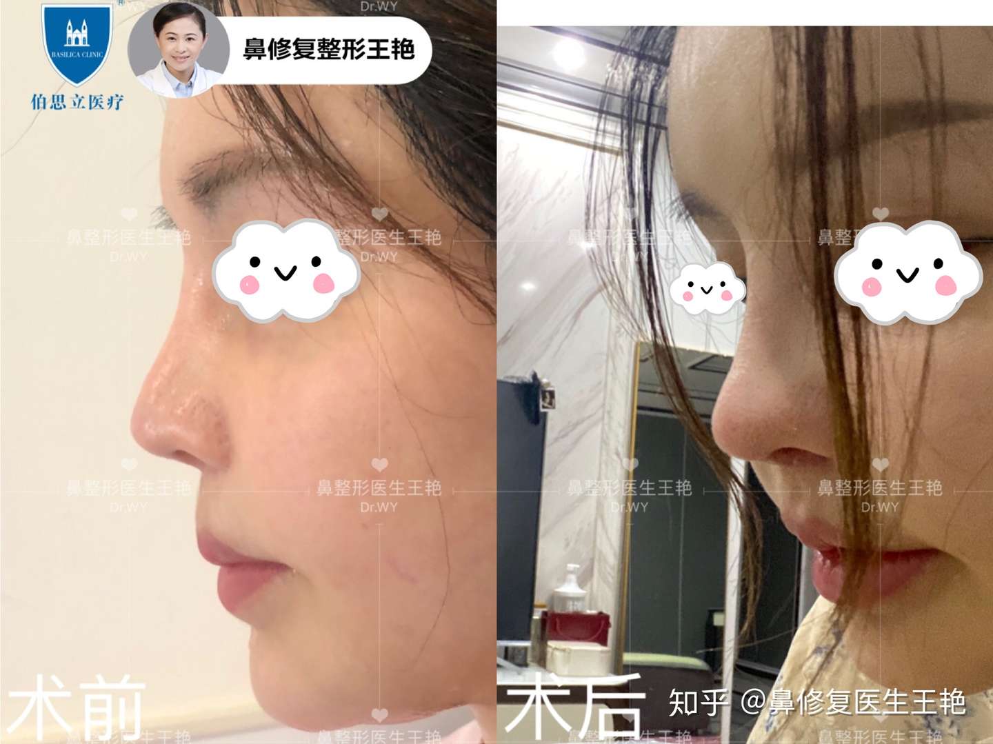 6次隆鼻后的鼻子是什么样的 知乎