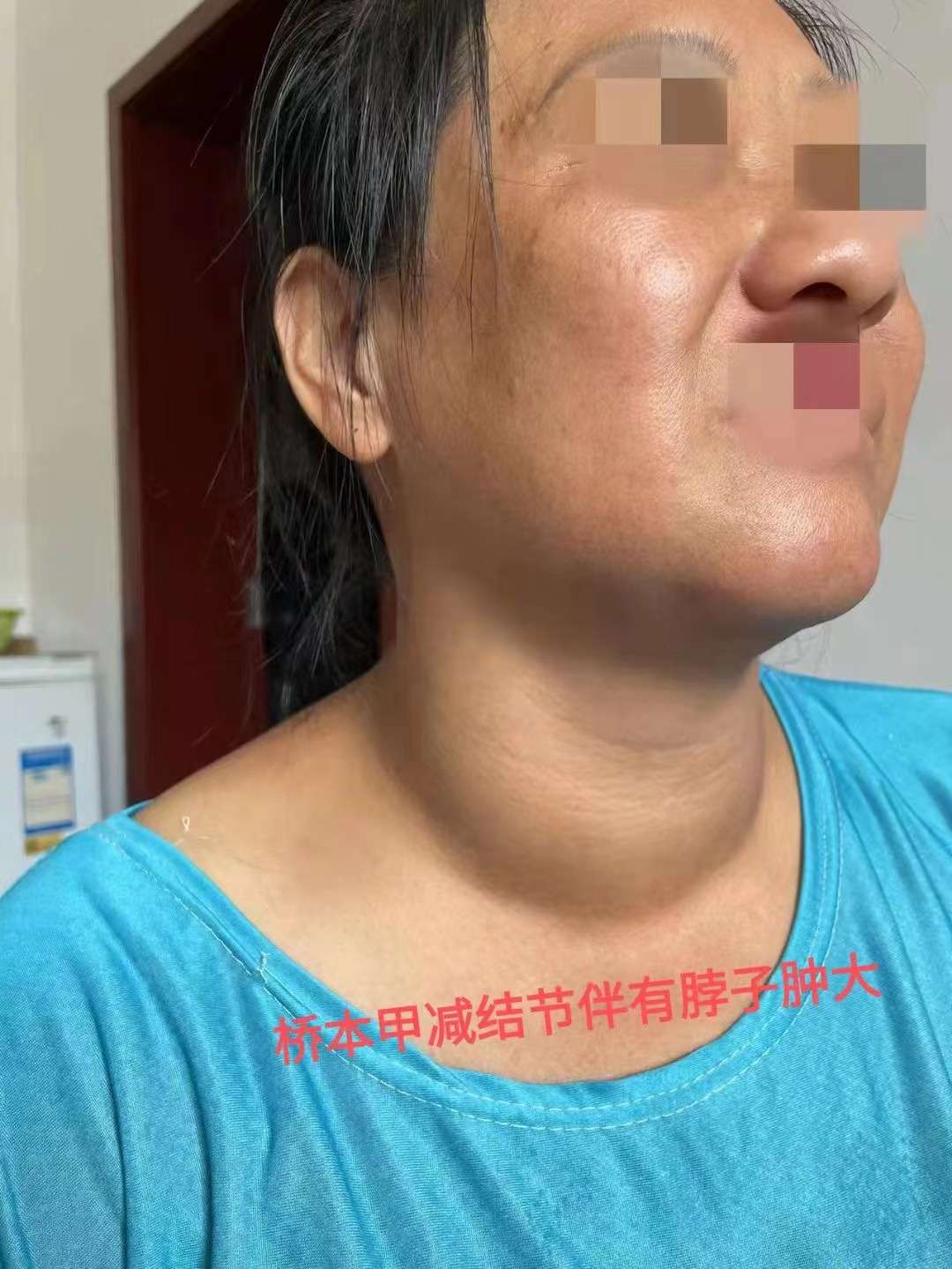 甲状腺肿大康复病例分享