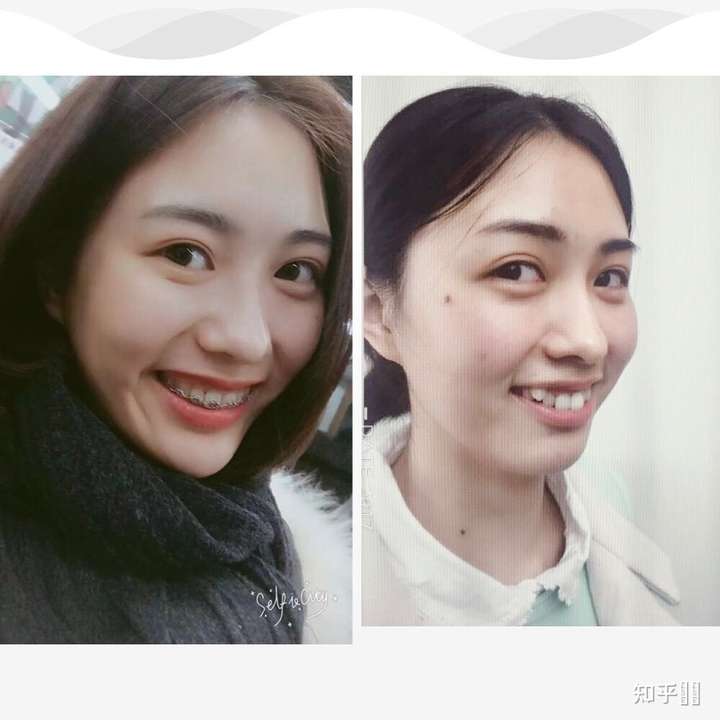 牙齒不齊真的很影響美觀嗎?